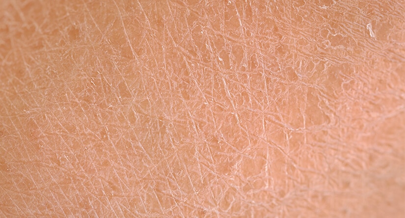 De verzorging van de droge huid: oorzaken, behandeling en preventie
