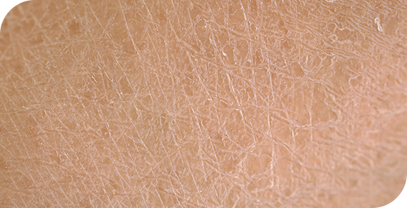 Macro-opname van een droge, schilferige huid waarop de textuur en fijne lijntjes duidelijk zichtbaar zijn.