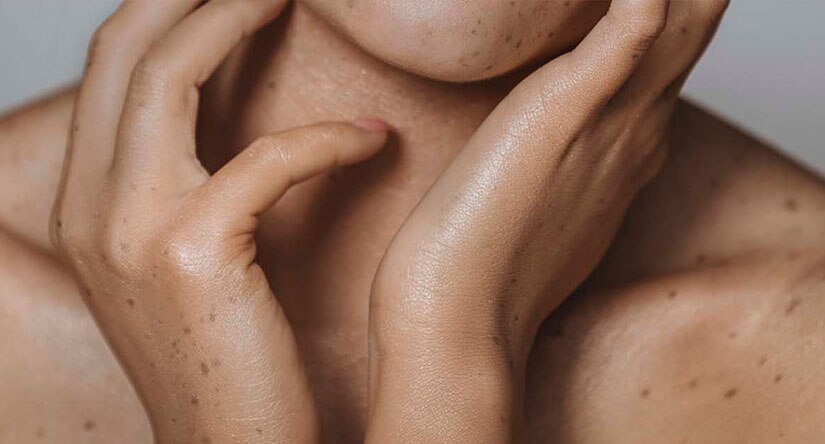 De verzorging van de eczeemhuid: symptomen, oorzaken, behandeling en preventie De verzorging van de eczeemhuid: symptomen, oorzaken, behandeling en preventie
