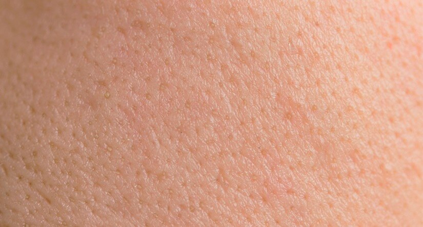 How to care for oily skin: Causes, treatment and prevention advice How to care for oily skin: Causes, treatment and prevention advice